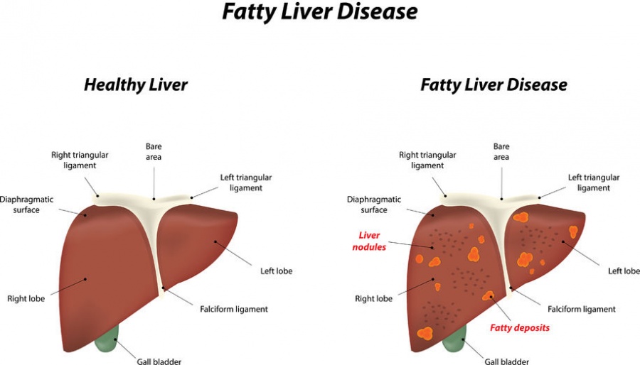 fattyliverdisease